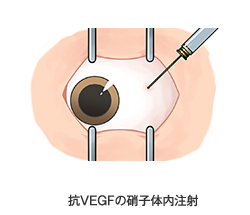 抗VEGFの硝子体内注射